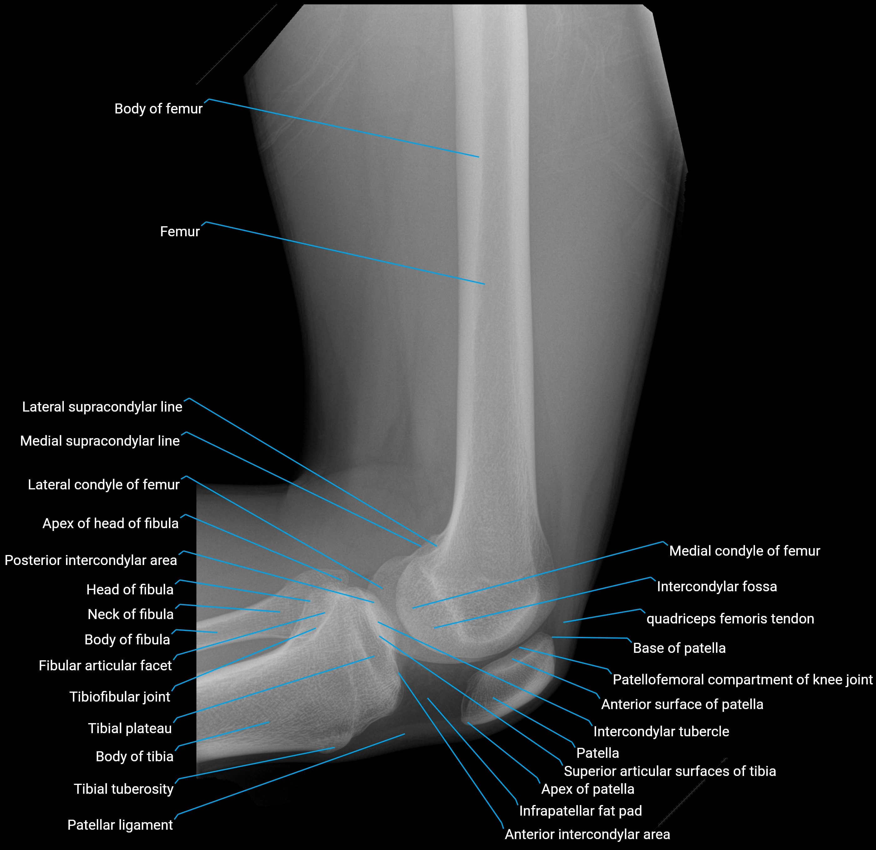 X ray femur lateral anatomy labelled image lower.webp